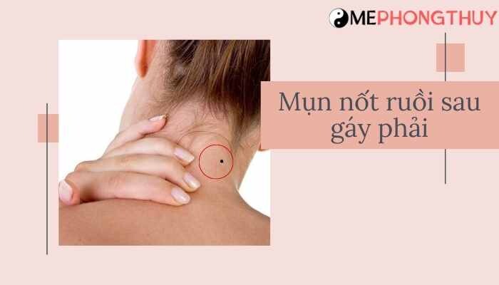 mụn nốt ruồi sau gáy phải