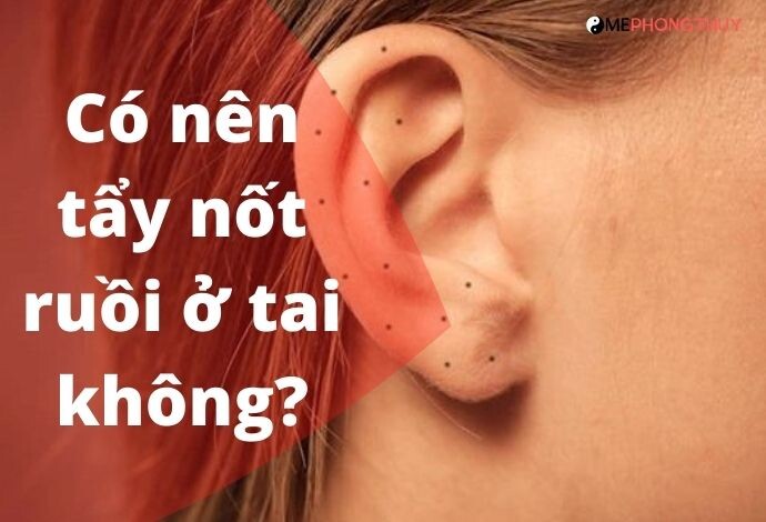 Có nên tẩy nốt ruồi ở tai không?