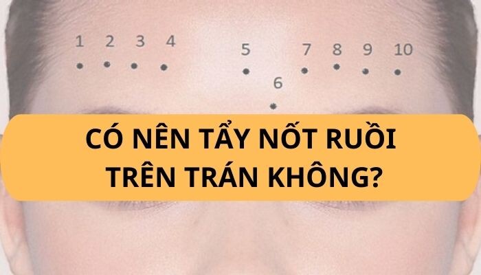 Có nên tẩy nốt ruồi trên trán không