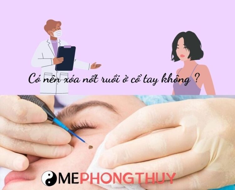 Có nên xóa nốt ruồi ở cổ tay không