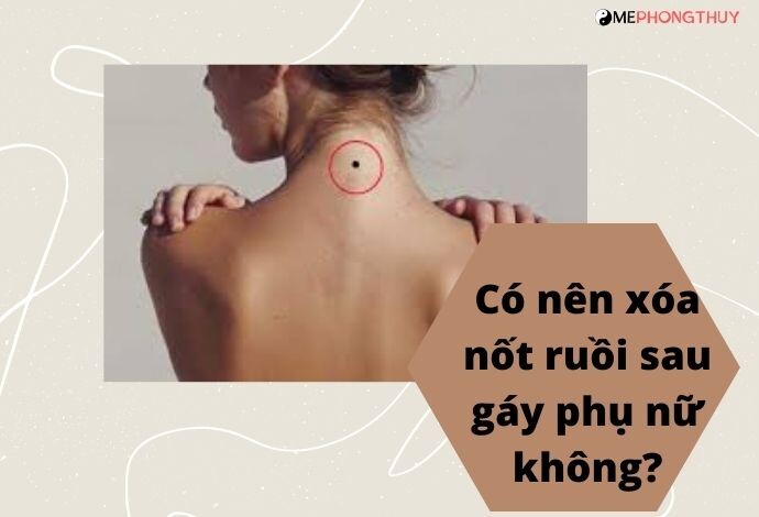 Có nên xóa nốt ruồi sau gáy phụ nữ không?