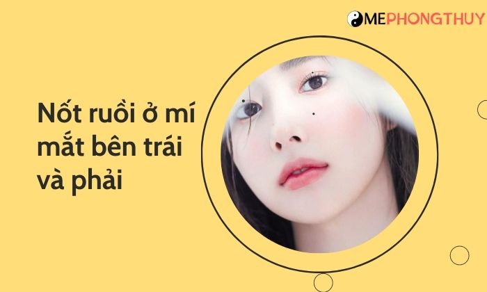 Nốt ruồi ở mí mắt bên trái và phải