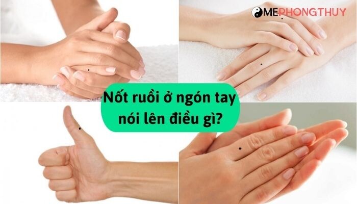 Nốt ruồi ở ngón tay nói lên điều gì